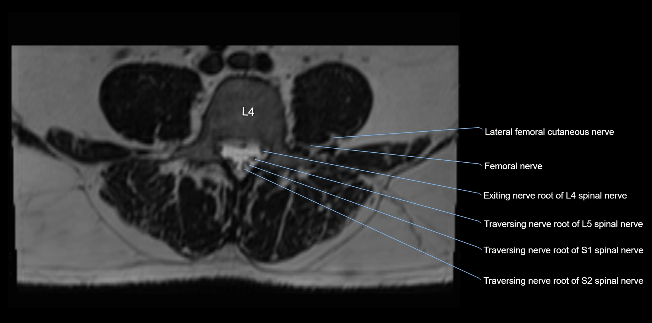 MR lumbosacral plexus axial cross sectional anatomy 3T  radiology  image-img-1008001-00038.webp